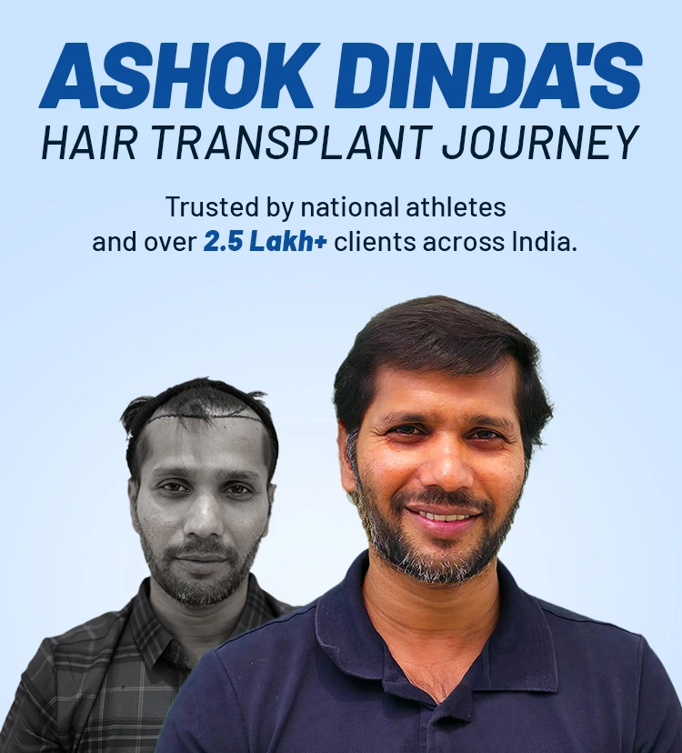 Ashok Dinda's hair transplant
